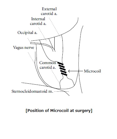 Microcoil position at surgery08282013.jpg